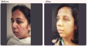 chin augmentation