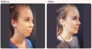 chin augmentation