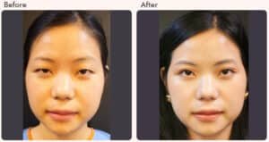 blepharoplasty