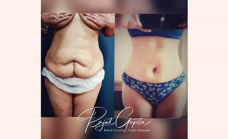 Beyond the Surface- The Deep Benefits of Tummy Tucks - Dr Rajat Gupta - Plastic Surgeon in Delhi -02 Tummy Tuck Surgery