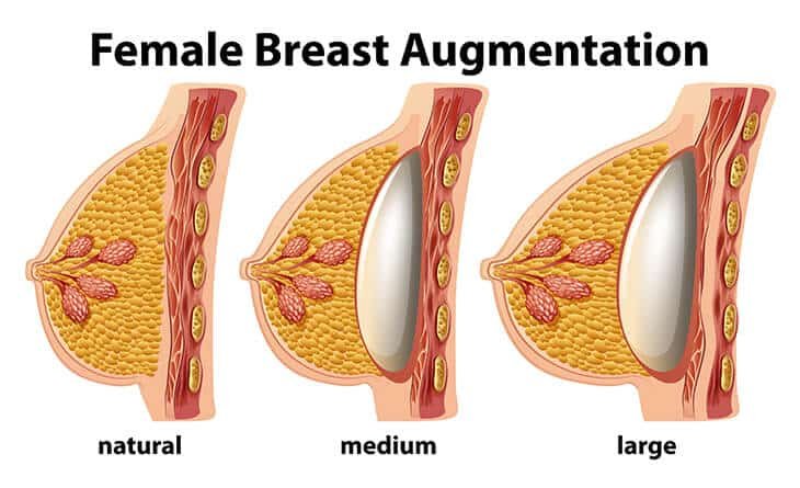 The Impact of Breast Augmentation on Self-Image - Dr Rajat Gupta - Plastic Surgeon in Delhi - RG Aesthetics -02 Breast Augmentation Surgery