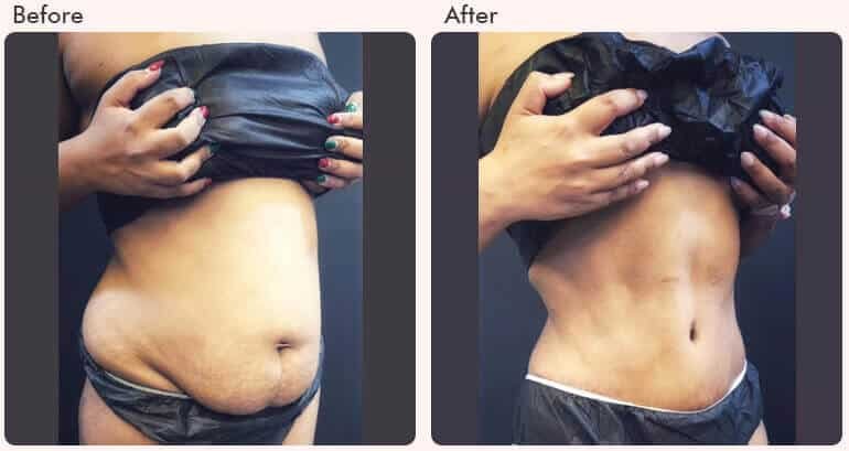 Tummy-Tuck-Surgery-Before-and-After-Result-RG-Aesthetics-06 tummy tuck surgery