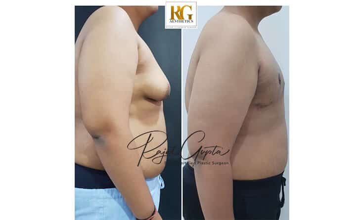 Gynecomastia Surgery Before and After Result - Dr Rajat Gupta - Plastic Surgeon in Delhi - RG Aesthetics -01 gynecomastia surgery before and after