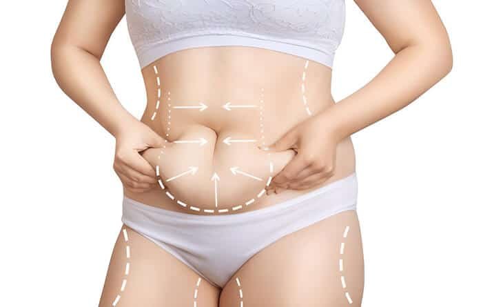 How Liposuction Can Help You Achieve Your Ideal Body Shape - Dr Rajat Gupta - Plastic Surgeon in Delhi - RG Aesthetics -02 Liposuction surgery