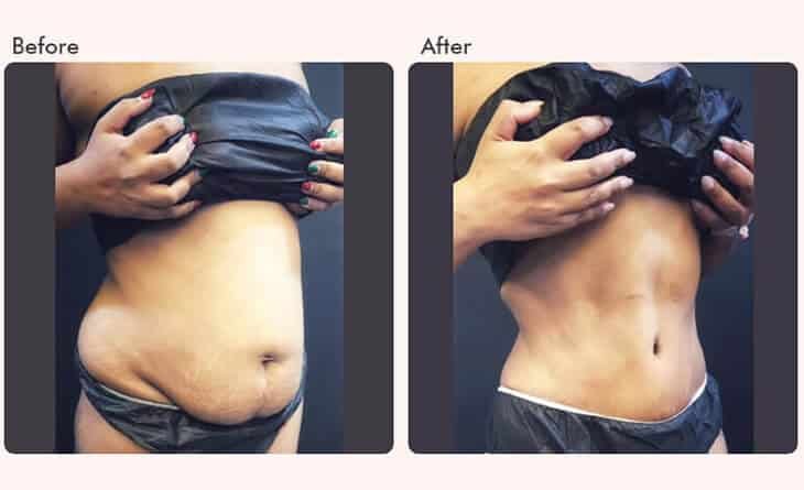 How to Achieve the Perfect Nose Without the Pain - Dr Rajat Gupta - Plastic Surgeon in Delhi - RG Aesthetics -02 tummy tuck surgery before and after