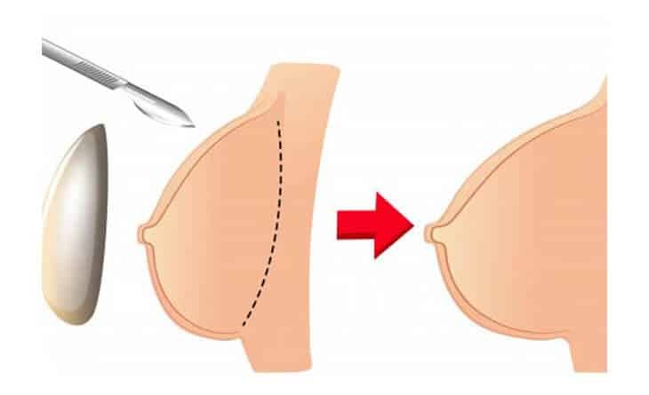 How to Prepare for Breast Reconstruction Surgery - Dr Rajat Gupta - Plastic Surgeon in Delhi - RG Aesthetics -01 Breast Reconstruction surgery