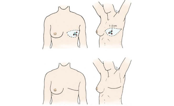 How to Prepare for Breast Reconstruction Surgery - Dr Rajat Gupta - Plastic Surgeon in Delhi - RG Aesthetics -02 Breast Reconstruction surgery