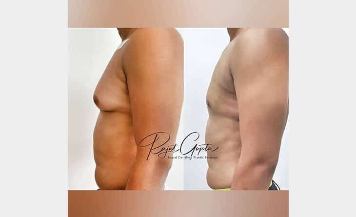 Will I Develop Loose Skin After Gynecomastia Surgery - Dr Rajat Gupta - Plastic Surgeon in Delhi - RG Aesthetics -02 Gynecomastia Surgery