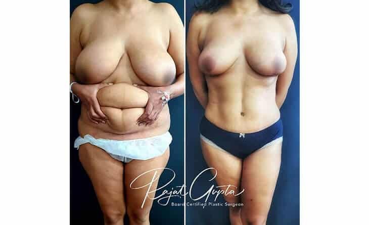Mommy Makeover Can Restore Your Confidence After Childbirth - Dr Rajat Gupta - Plastic Surgeon in Delhi -02 Mommy Makeover Surgery