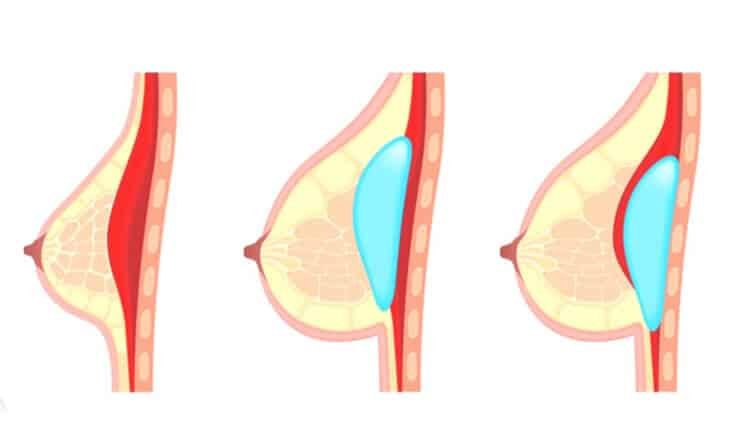 Natural Breast Augmentation- Curves Without Implants - Dr Rajat Gupta - Plastic Surgeon in Delhi -02 Breast augmentation surgery