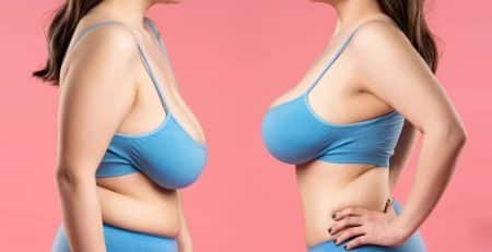 Perky breast surgery
