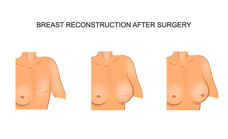 The Impact of Breast Reconstruction Surgery on Self-Esteem - Dr Rajat Gupta - Plastic Surgeon in Delhi -01 Breast Reconstruction surgery