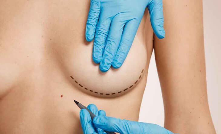 Benefits of Breast Reconstruction After Fighting Cancer - Dr Rajat Gupta - Plastic surgeon in Delhi - 01 Breast reconstruction surgery