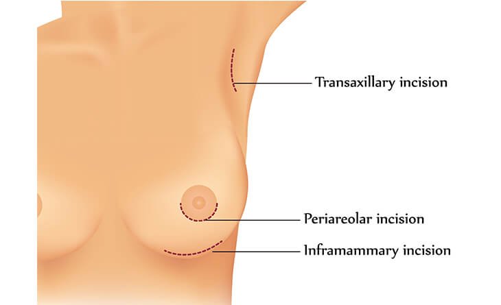 Choosing the Right Surgeon for Breast Augmentation - Dr Rajat Gupta - Plastic surgeon in Delhi - 01 breast augmentation surgery
