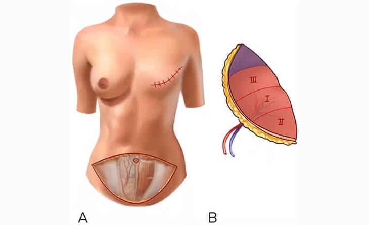 Choosing the Right Surgeon for Your Breast Reconstruction - Dr Rajat Gupta - Plastic Surgeon in Delhi -01 Breast Reconstruction Surgery