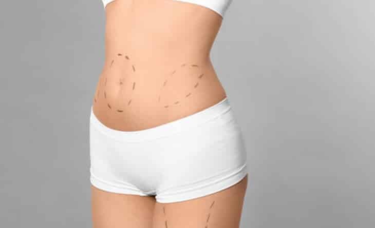 High-Definition Liposuction- Sculpt Your Body with Precision - Dr Rajat Gupta - Plastic Surgeon in Delhi -02 High-Definition Liposuction