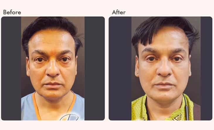 Blepharoplasty Surgery- The Secret to Brighter - Dr Rajat Gupta - Plastic Surgeon in Delhi - RG Aesthetics -01 blepharoplasty surgery before and after