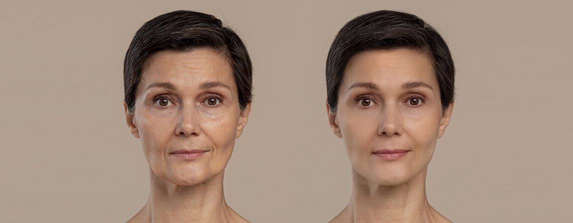 Facial Contouring Surgery
