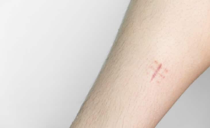 Can Plastic Surgery Remove Scars from Stitches - Dr Rajat Gupta - Plastic Surgeon in Delhi -02 Remove Scars From Stitches