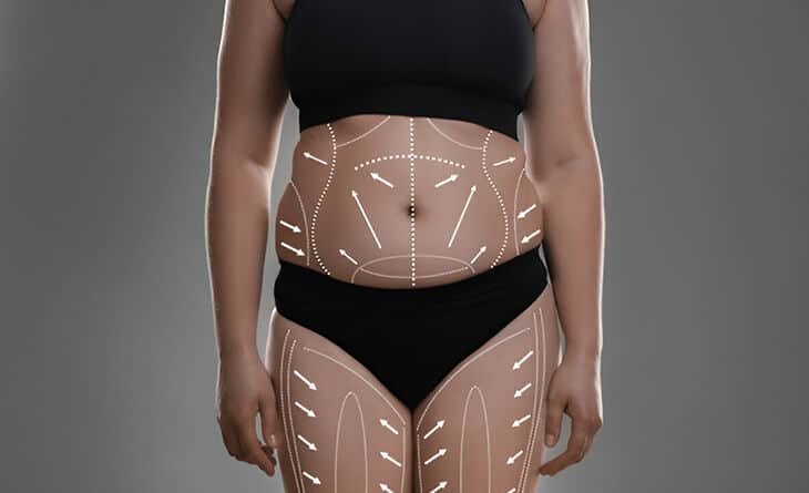 Can You Get a Brazilian Butt Lift with a Tummy Tuck - Dr Rajat Gupta - Plastic Surgeon in Delhi - RG Aesthetics -02 Tummy Tuck Surgery
