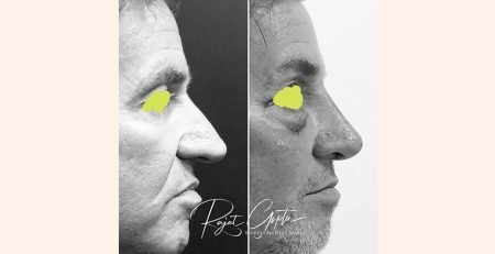 Celebrity Rhinoplasty Surgery