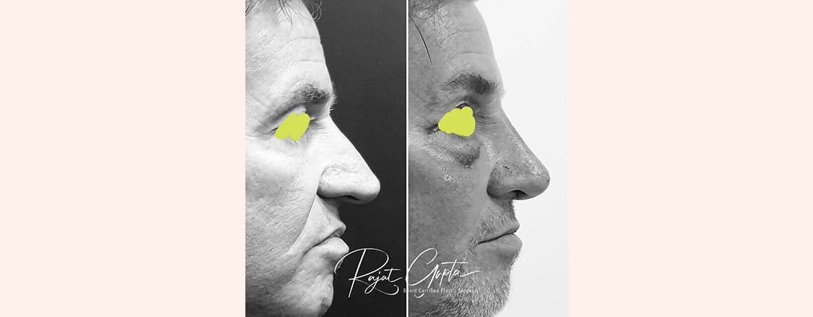 Celebrity Rhinoplasty Surgery