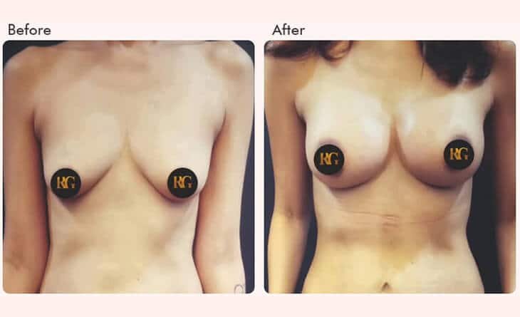 Importance of Size and Proportion in Breast Augmentation - Dr Rajat Gupta - Plastic Surgeon in Delhi -02 Breast augmentation surgery before and after