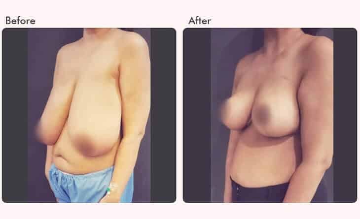 Is Breast Reduction Surgery Right for You - Dr Rajat Gupta - Plastic Surgeon in Delhi - RG Aesthetics -02 breast reduction surgery before and after