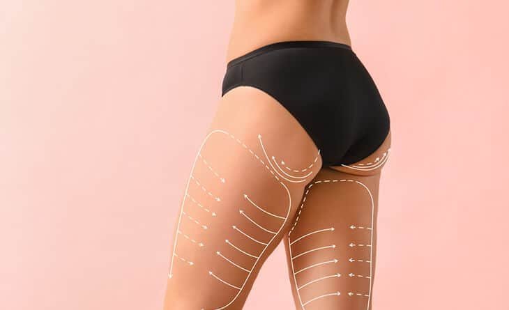 What Is a Thigh Lift Surgery - Dr Rajat Gupta - Cosmetic Surgeon in Delhi- RG Aesthetics -02 thigh lift surgery