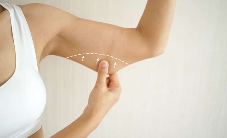 What You Need to Know About Arm Lift Surgery - Dr Rajat Gupta - Plastic Surgeon in Delhi -02 arm lift surgery