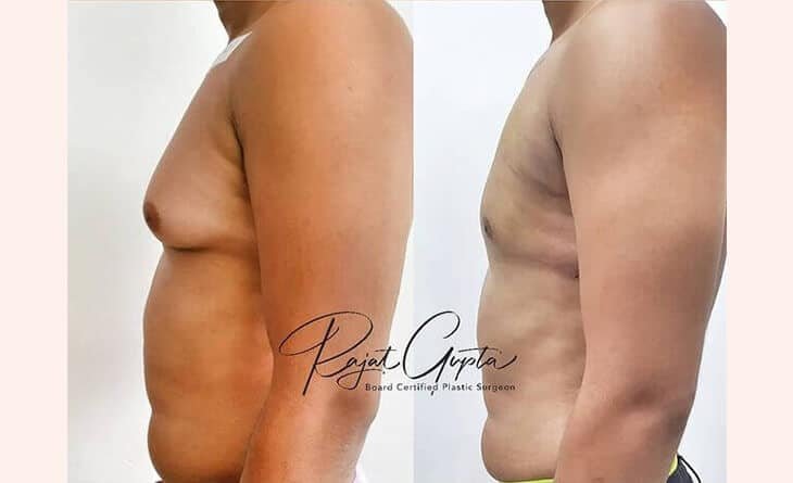 Best Gynecomastia Surgery in Delhi with Scarless Procedures- Dr Rajat Gupta - Plastic Surgeon in Delhi -02 gynecomastia surgery before and after
