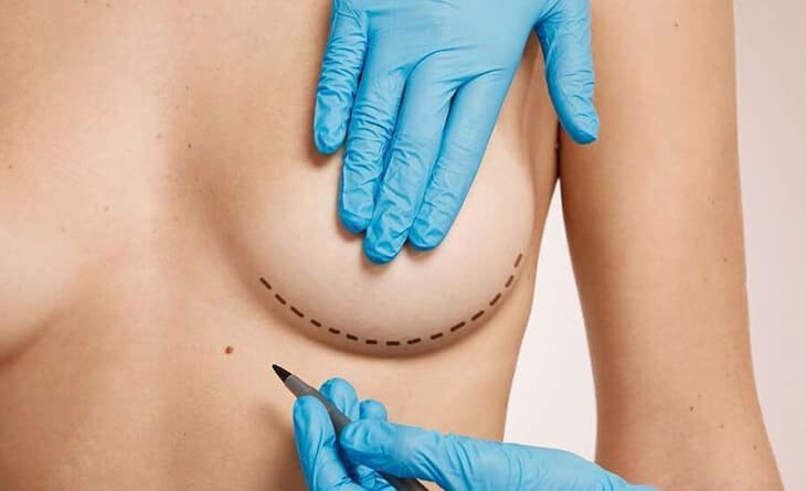 Breast Reconstruction Surgery After Breast Cancer - Dr Rajat Gupta - Plastic Surgeon in Delhi - RG Aesthetics -02 breast reconstruction surgery