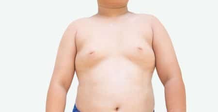 gynecomastia surgery