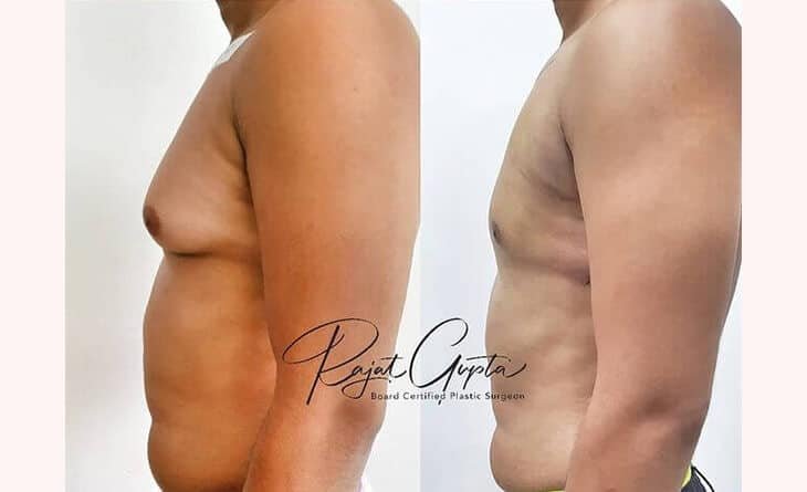 Can Gynecomastia Come Back After Surgery - Dr Rajat Gupta - Plastic Surgeon in Delhi -02 gynecomastia surgery before and after