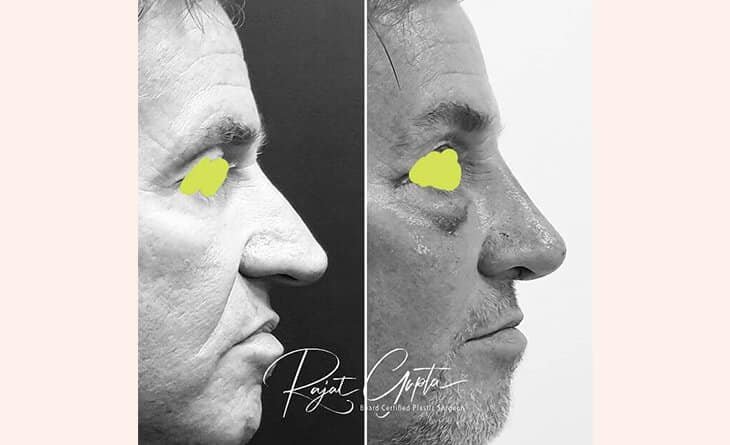 Factors to Consider Before Choosing a Rhinoplasty Surgeon in Delhi - Dr Rajat Gupta - Plastic Surgeon in Delhi - RG Aesthetics -02 Nose job surgery before and after