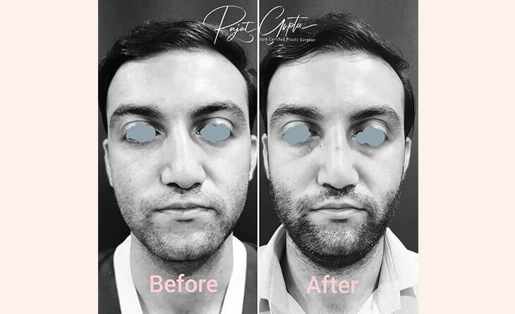 Factors to Consider Before Choosing a Rhinoplasty Surgeon in Delhi - Dr Rajat Gupta - Plastic Surgeon in Delhi - RG Aesthetics -03 Rhinoplasty Surgery before and after