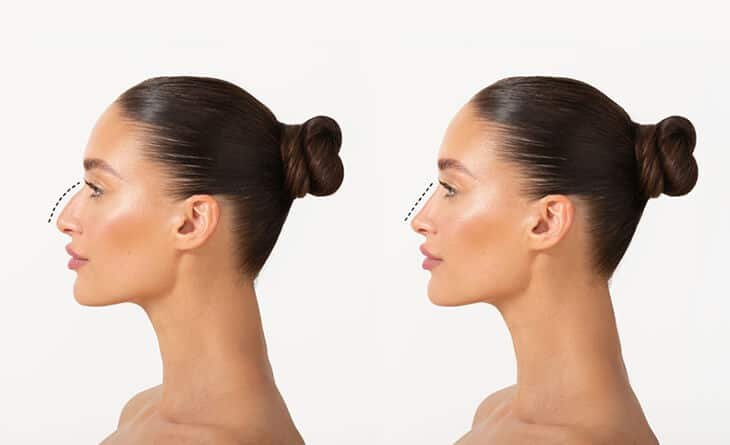 Rhinoplasty for Men vs Women - Dr Rajat Gupta - Plastic Surgeon in Delhi -02 nose reshaping surgery