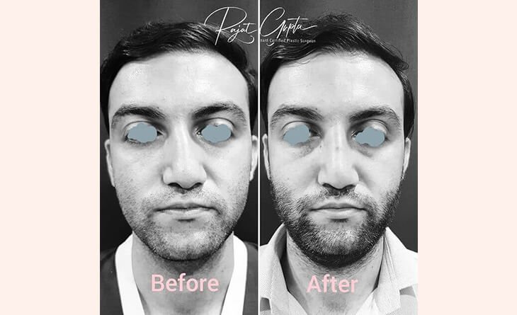 Rhinoplasty in India- Whats the Best Age for a Nose Job - Dr Rajat Gupta - Plastic Surgeon in Delhi -02 Rhinoplasty surgery before and after