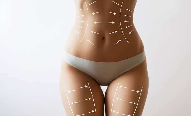 Tips to Maintain Better Results After Liposuction - Dr Rajat Gupta - Plastic Surgeon in Delhi - RG Aesthetics -02 liposuction surgery