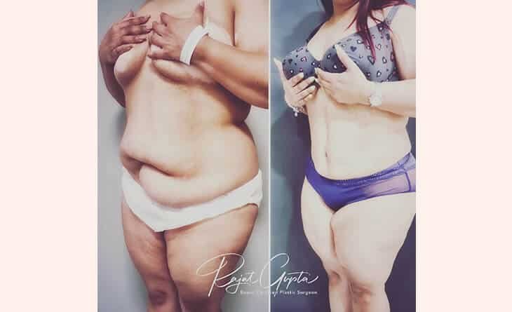 Tummy Tuck Surgery for Flat Belly That You Desire - Dr Rajat Gupta - Plastic Surgeon in Delhi - RG Aesthetics -02 tummy tuck surgery