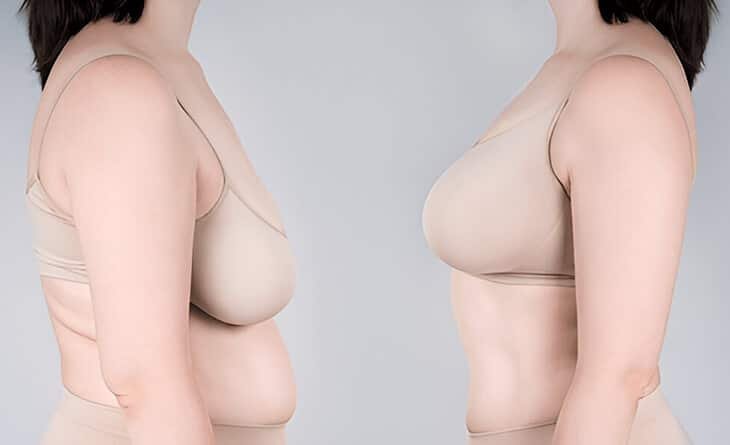 Upper Pole Fullness Breast Reduction - Dr Rajat Gupta - RG Aesthetics -01 Upper Pole Fullness Breast Reduction