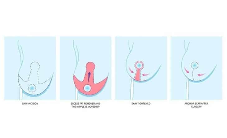 Upper Pole Fullness Breast Reduction - Dr Rajat Gupta - RG Aesthetics -02 Upper Pole Fullness Breast Reduction