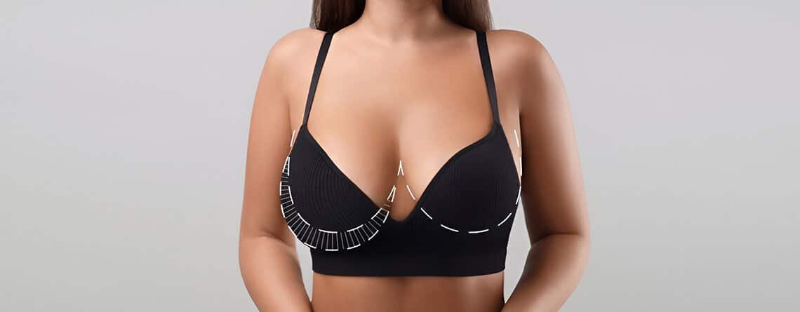 Upper Pole Fullness Breast Reduction - Dr Rajat Gupta - RG Aesthetics -03 Upper Pole Fullness Breast Reduction