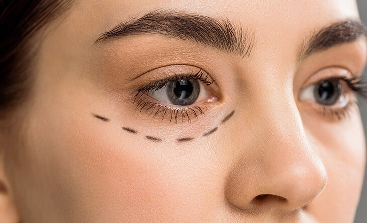 Who is an Ideal Candidate for Lower Blepharoplasty Surgery - Dr Rajat Gupta - Plastic Surgeon in Delhi -01 lower blepharoplasty surgery