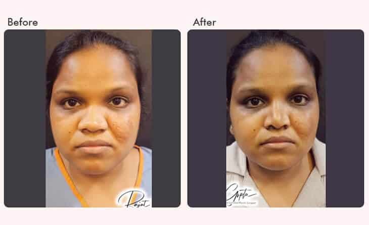 Why Celebrity Nose Jobs Are So Popular- All You Need to Know - Dr Rajat Gupta - Plastic Surgeon in Delhi -02 rhinoplasty surgery before and after