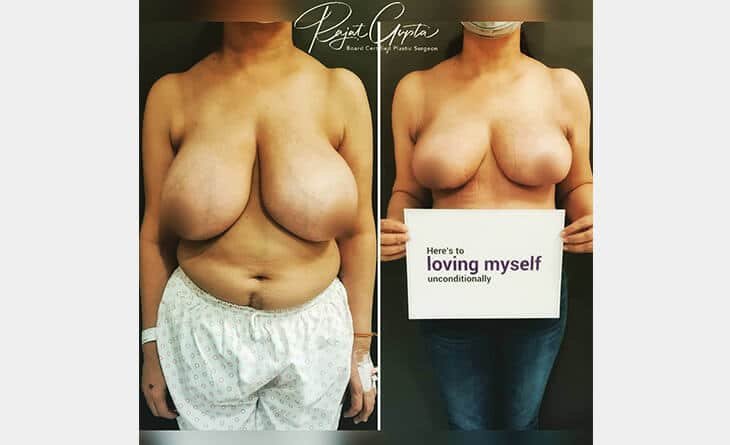 Breast Reduction Surgery for Chronic Pain Relief - Dr Rajat Gupta - Cosmetic Surgeon in India - RG Aesthetics -02 Breast Reduction Surgery