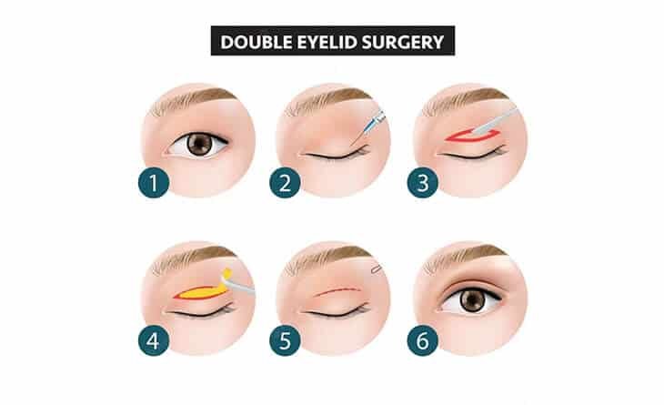 Getting Double Eyelids- Is Surgery Safe and Necessary - Dr Rajat Gupta - Plastic Surgeon in Delhi -01 double eyelid surgery