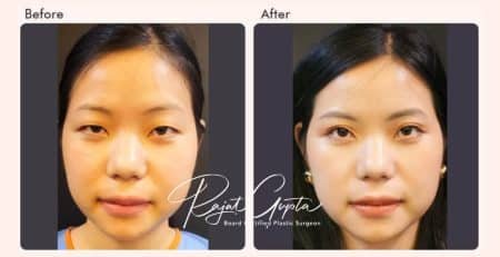 double eyelid surgery