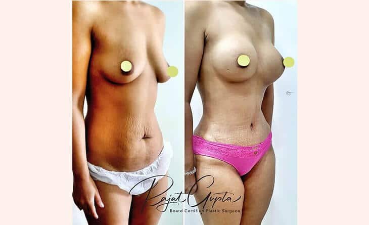 How Abdominoplasty Helps Flatten Your Tummy - Dr Rajat Gupta - Plastic Surgeon in Delhi -01 tummy tuck surgery before and after