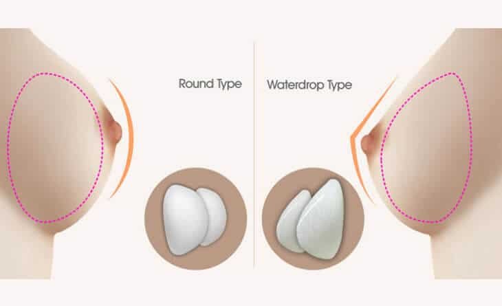 How to Choose the Correct CCs for Your Implant - Dr Rajat Gupta - Plastic Surgeon in Delhi -RG Aesthetics 01 Breast implant